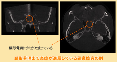 蝶形骨洞まで炎症が進展している副鼻腔炎の例
